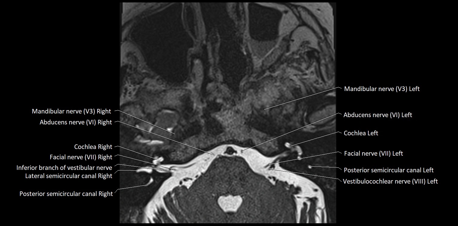 Cranial nerve anatomy axial MRI 3T image 54.webp